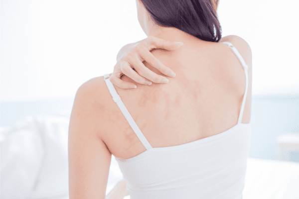 Eczema: Functional Medicine Approach