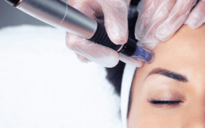What is Microneedling and Can I Benefit From it?